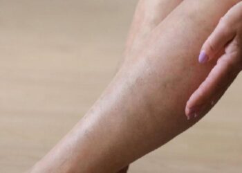 Sıcak havalar varis şikayetlerini de arttırıyor!