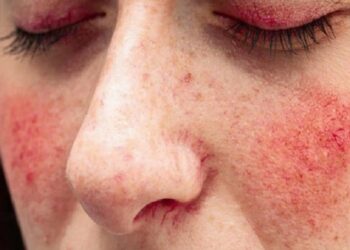 Sıcaklar ‘gül hastalığı’na dikkat!