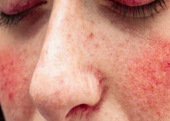 Sıcaklarda ‘gül hastalığı’na dikkat!