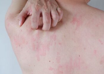 Ürtiker Hastalığında Beslenme Tedavisi Ve Dünya Ürtiker Günü Farkındalığı