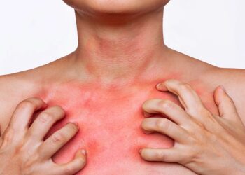 Uyuz Vakalarında Hızlı Artış