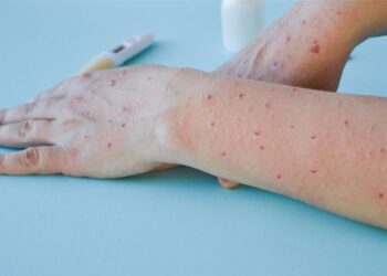 Yeni Pandeminin Adı Maymun Çiçeği Olacak