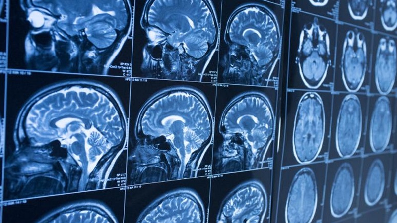 Alzheimer ve Parkinson İçin Erken Teşhiste Çığır Açan Protein Haritası