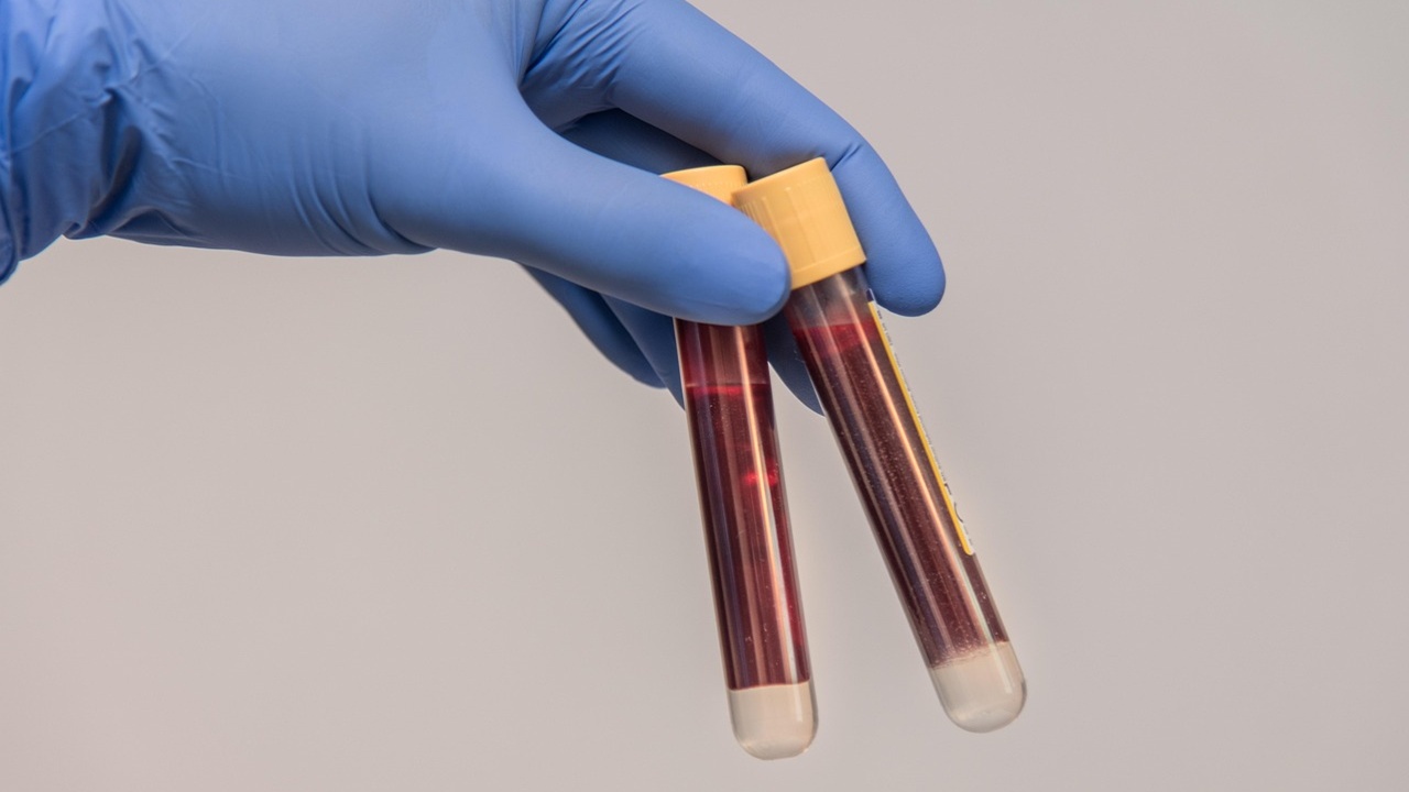 VolitionRX, Sadece Kan Testiyle Kanseri Tespit Edebilen Yeni Yöntemini Tanıttı